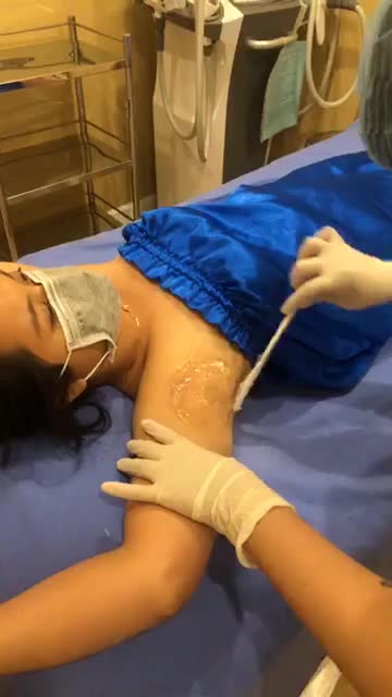 TRIỆT LÔNG BẰNG CÔNG NGHỆ DIODE LASER