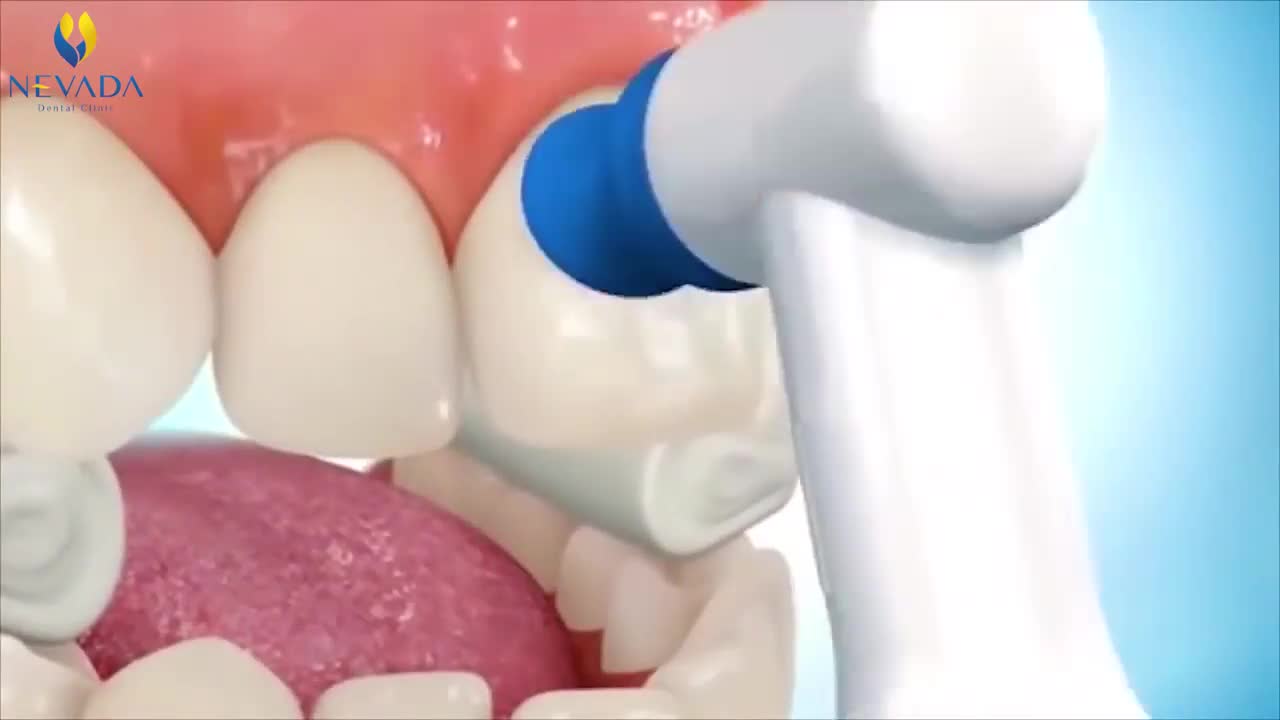 BẠN THẮC MẮC KHÔNG BIẾT QUY TRÌNH NIỀNG RĂNG MẮC CÀI DIỄN RA THẾ NÀO ?