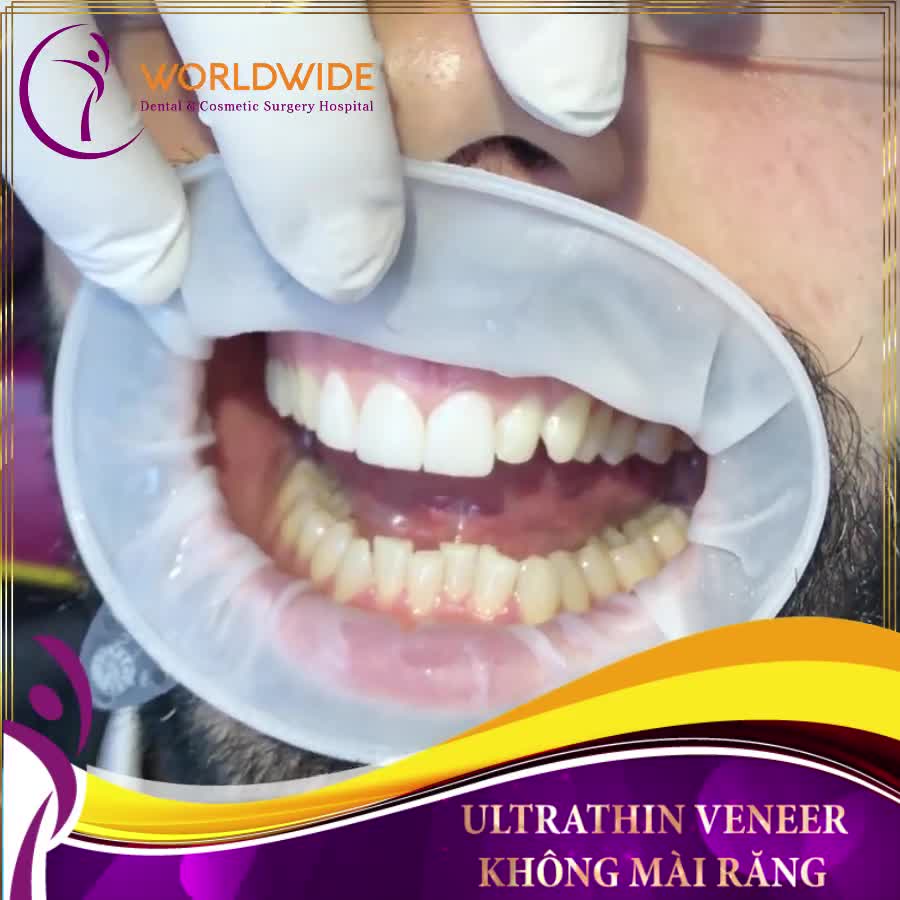 CẬN CẢNH LẮP VENEER SIÊU MỎNG - KHÔNG MÀI RĂNG TẠI NHA KHOA DR HÙNG BỆNH VIỆN WORLDWIDE