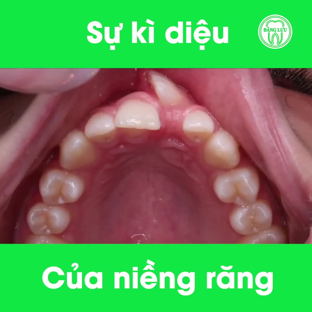 Động lực dành cho những bạn muốn niềng răng nhưng còn lo ngại.