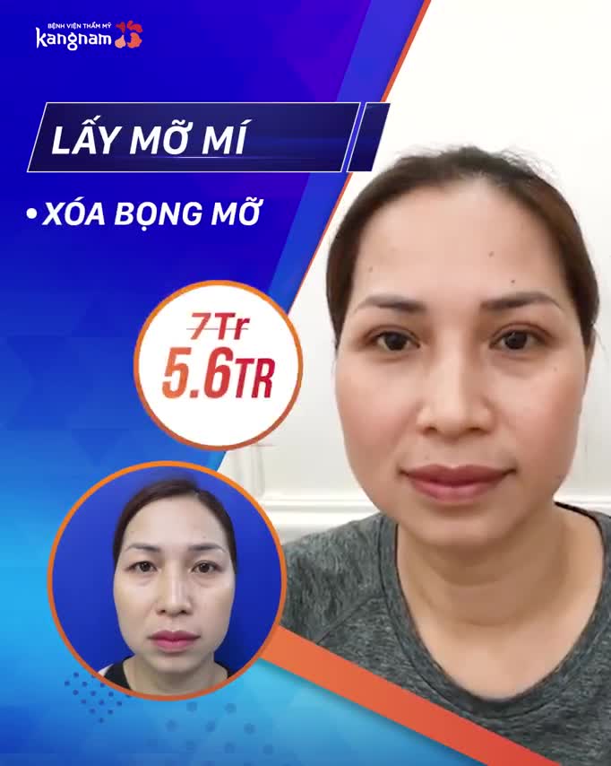 Cập nhật Giá Thẩm Mỹ Mắt hè này ‼️ SALE SỐC chỉ từ 6.75TR