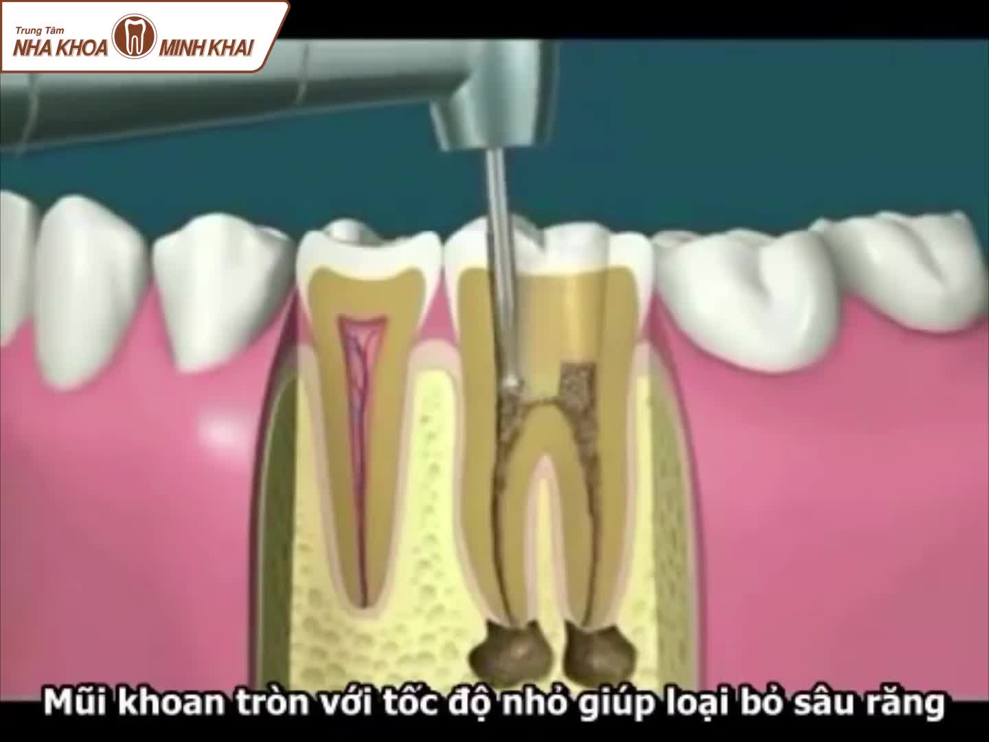 CHẤM DỨT CƠN ĐAU VIÊM TỦY VỚI NHA KHOA MINH KHAI