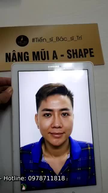 NÂNG MŨI A-SHAPE