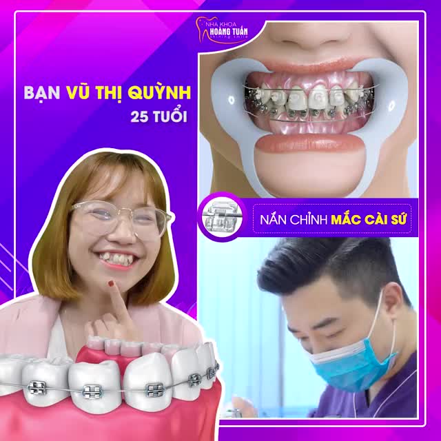 Nụ cười thay đổi kỳ diệu nhờ chỉnh nha