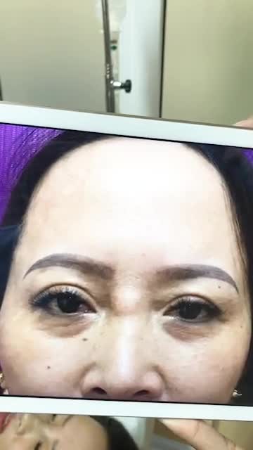 Khách hàng đã từng tiêm filler ở spa và gặp phải tình trạng vón cục ở sống mũi.