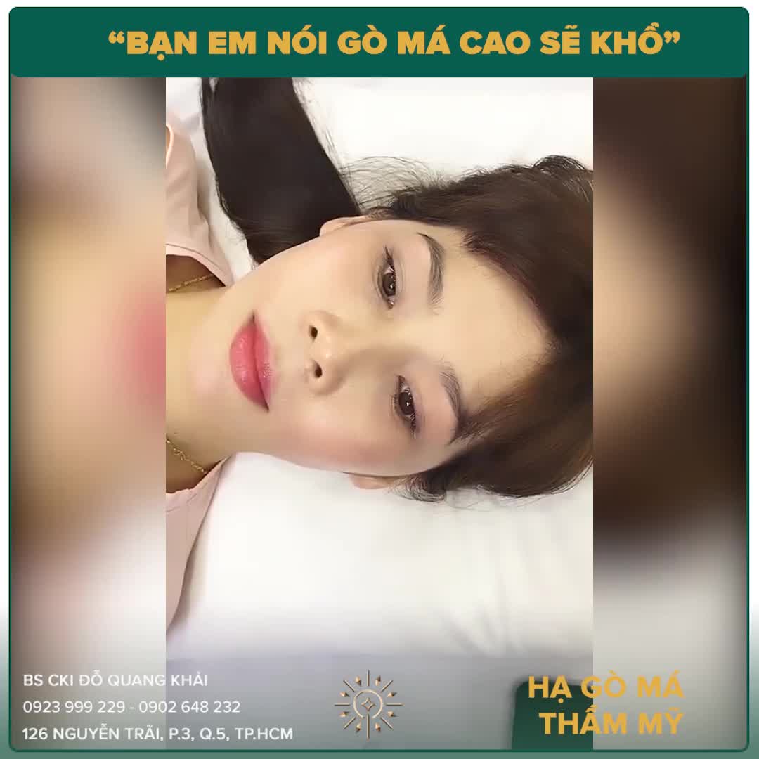 Chị khách hàng ban đầu có gò má gồ cao gây ra tình trạng hóp thái dương, đường nét trên mặt góc cạnh.
