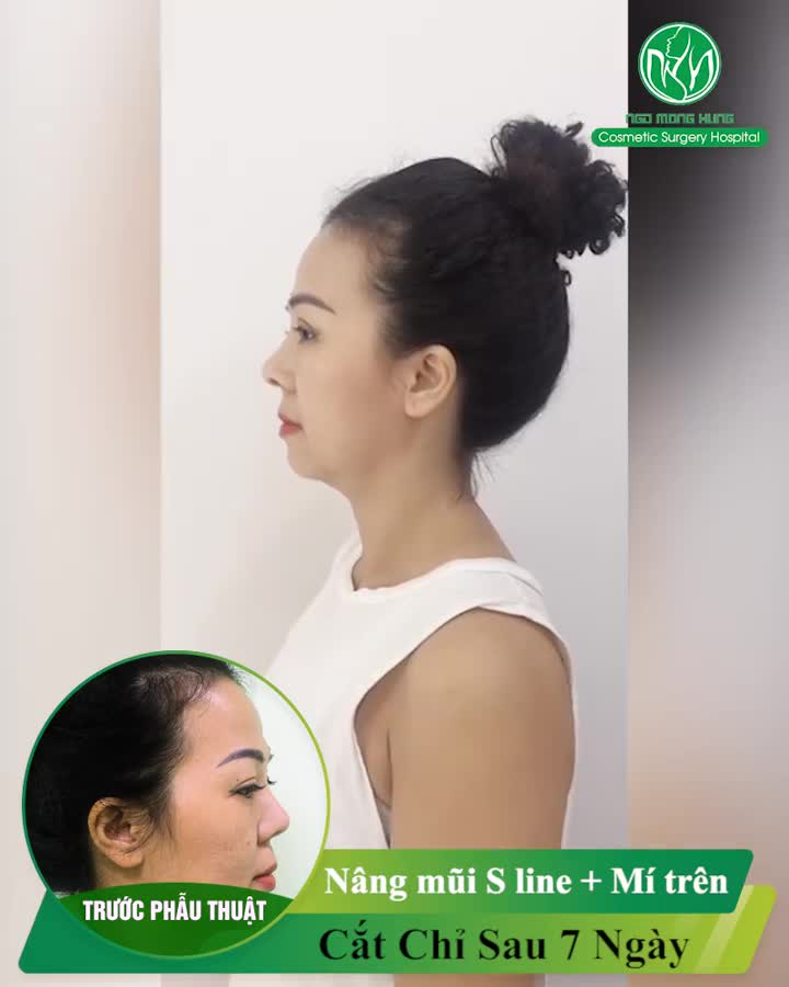 Chị khách quay trở lại cắt chỉ sau khi làm mí trên và nâng mũi S Line tại Bệnh viện Thẩm mỹ Ngô Mộng Hùng