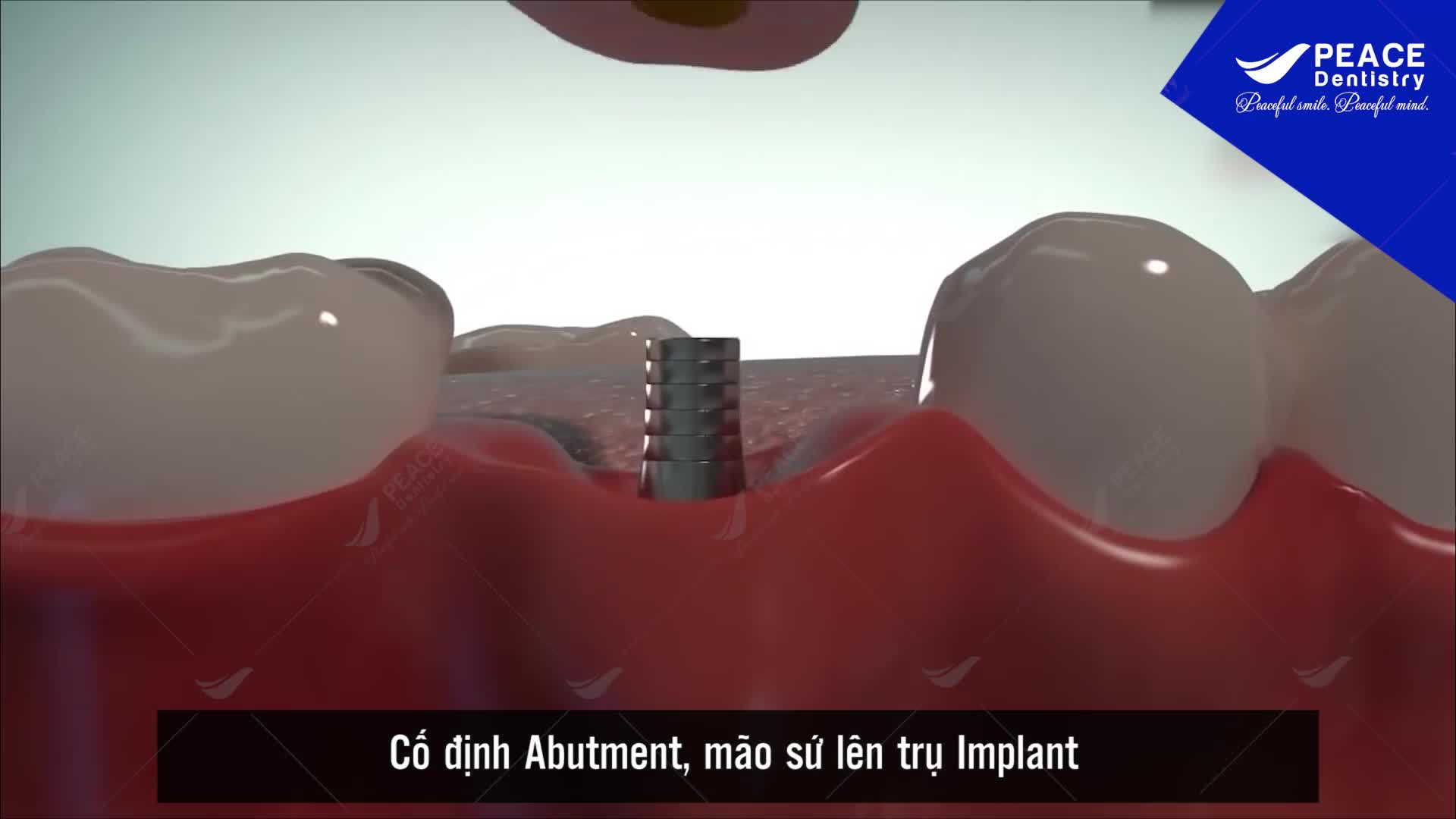 TRỒNG RĂNG IMPLANT - Giải pháp trồng răng giả ưu việt nhất