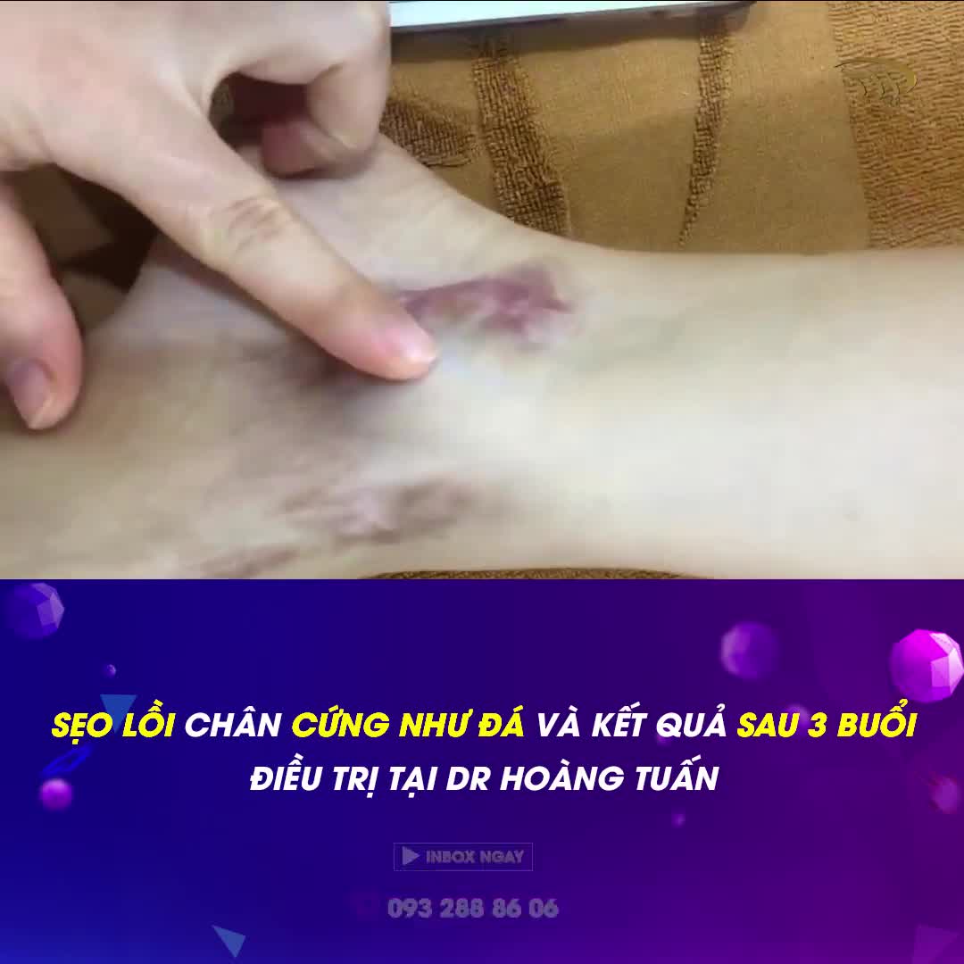 SẸO LỒI CỨNG NHƯ ĐÁ VÀ PHƯƠNG PHÁP ĐIỀU TRỊ