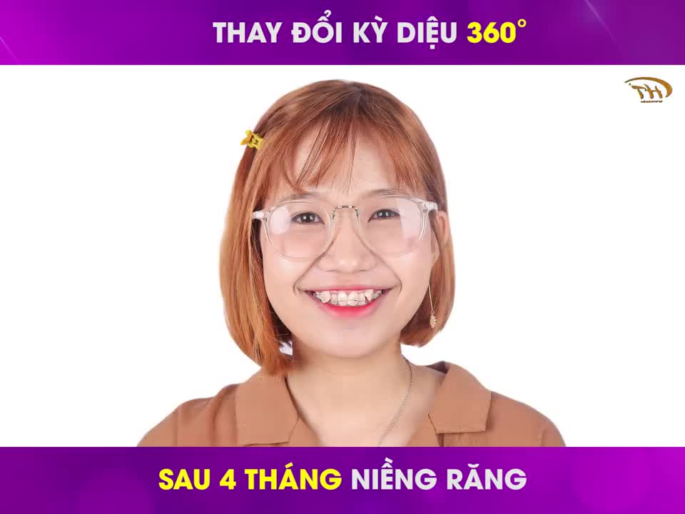 Răng 9630 sau 4 tháng niềng răng