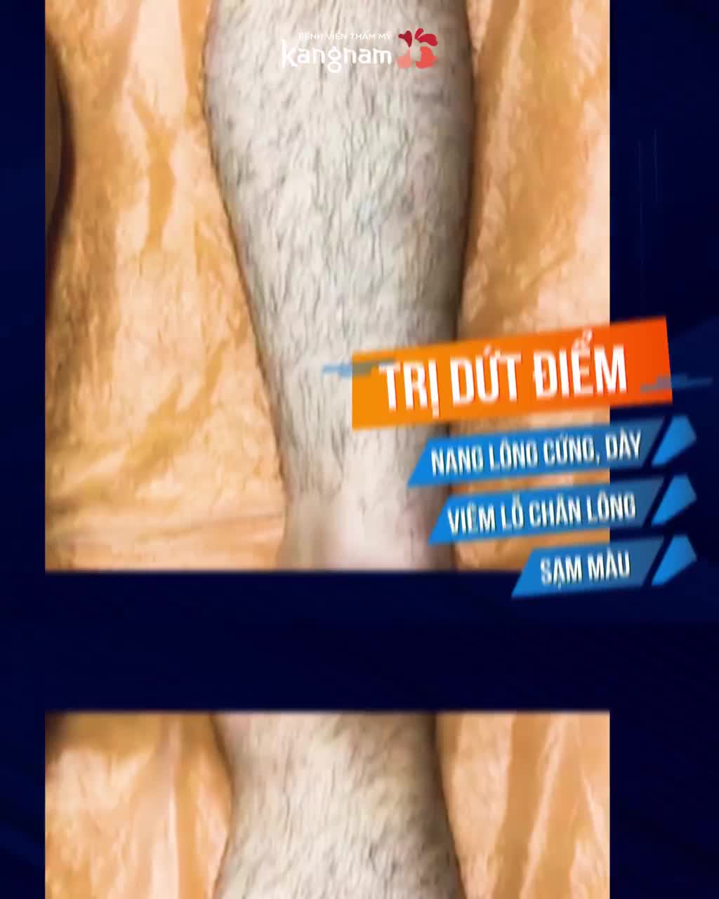 Bye Bye sợi Lông Chân Tay Nách DÀI RẬM CỨNG ĐEN xấu xí