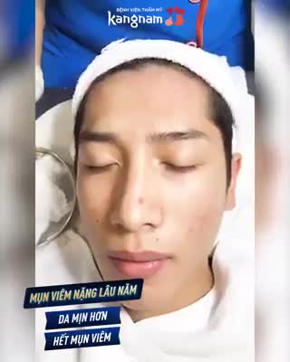 Trị mụn có hết không?