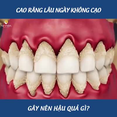 ĐÃ BAO LÂU RỒI BẠN CHƯA LẤY CAO RĂNG?