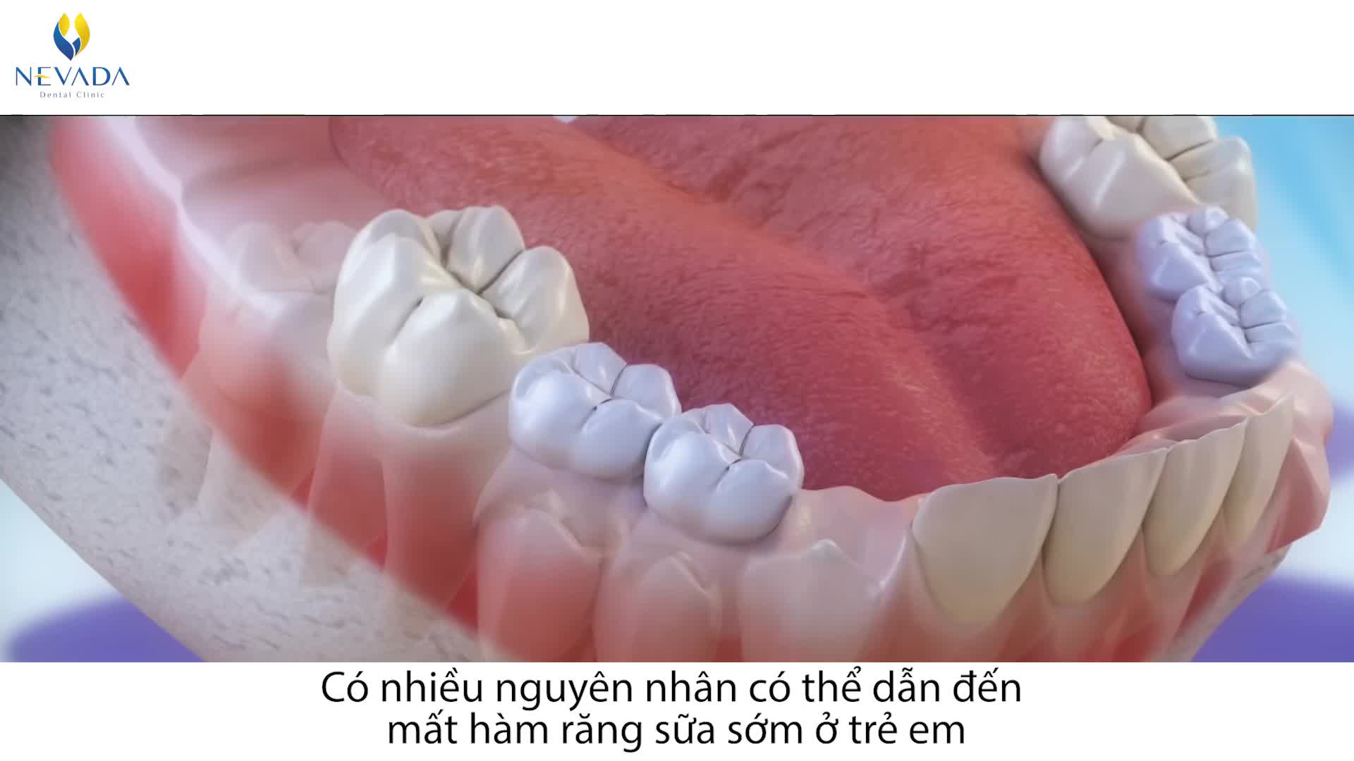 CON BỊ MẤT RĂNG SỮA QUÁ SỚM DO SÂU RĂNG - Phải làm sao?