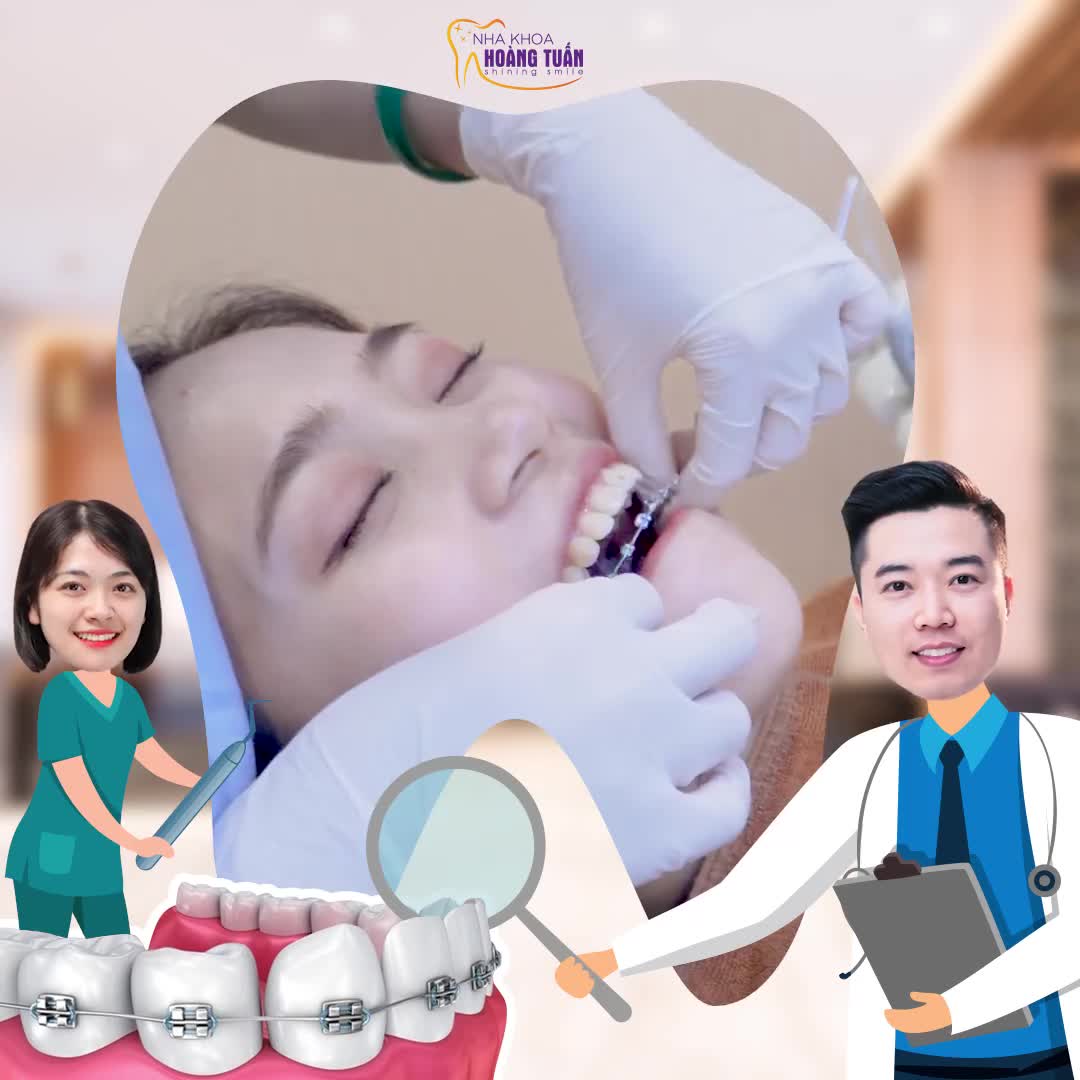 NIỀNG RĂNG CƯỜI XINH