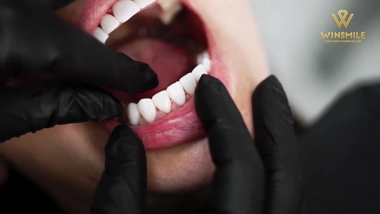 Đã từng rất sợ làm răng sứ vì răng phải MÀI NHỎ