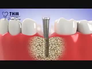 MẤT RĂNG – VIỆC TRỒNG LẠI RĂNG LIỆU CÓ CẦN THIẾT