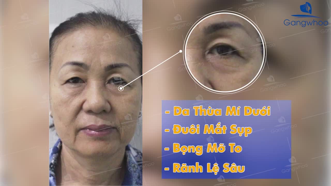 KỸ THUẬT TRẺ HÓA MẮT CANTHOPEXY ĐỘC QUYỀN GANGWHOO - LẤY LẠI 10 NĂM TUỔI XUÂN CHỈ VỚI 45 PHÚT