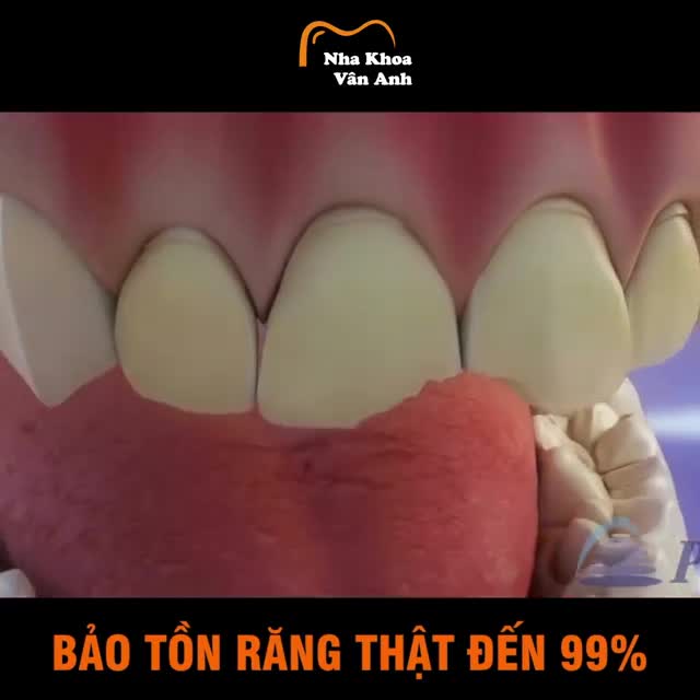 DÁN SỨ VENEER CHUẨN ĐỨC - KHÔNG MÀI NHỎ - KHÔNG ĐAU