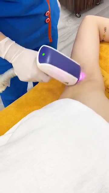 Kết quả Sau 3 BUỔI triệt lông với Diode Laser tại Kangnam