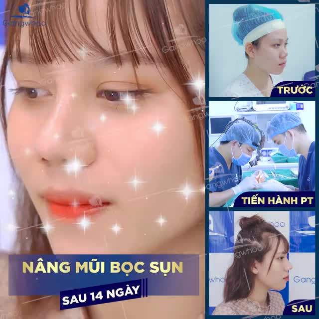 DÁNG MŨI CAO BAY, ĐÁNH BẬT NGAY MỌI KHUYẾT ĐIỂM