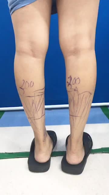 Bắp chân nhỏ sẽ được bác sĩ giải quyết như thế nào