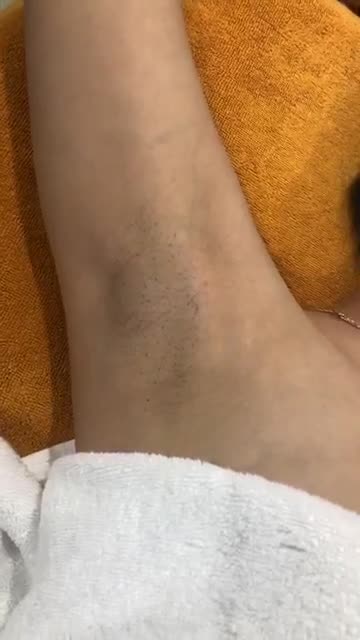 Diode Laser - Triệt sạch lông mọi phân vùng cơ thể - Hiệu quả vĩnh viễn