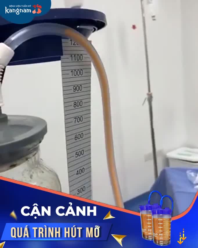 Chứng kiến CẬN CẢNH QUÁ TRÌNH HÚT MỠ