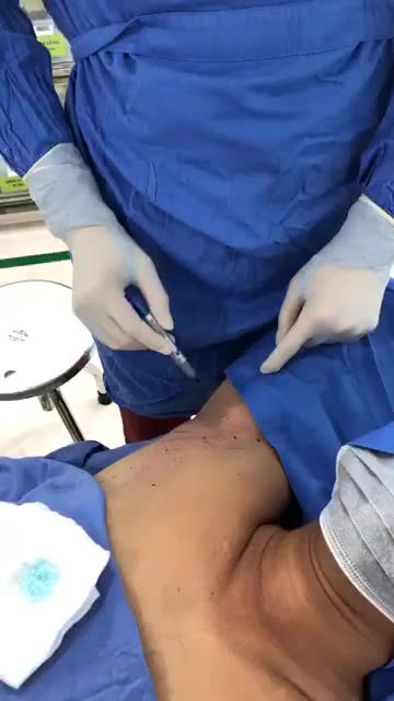 Chiếu sáng laser trong công nghệ trị tuyến mồ hôi nách Endodry