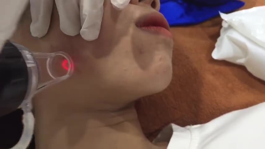 ĐIỀU TRỊ SẸO LỒI VỚI CÔNG NGHỆ ACUPLUSE