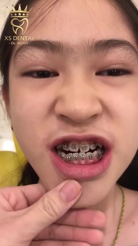 Hoàn thành ca niềng răng cho Bé Gái Hà Phưởng - 11 tuôi