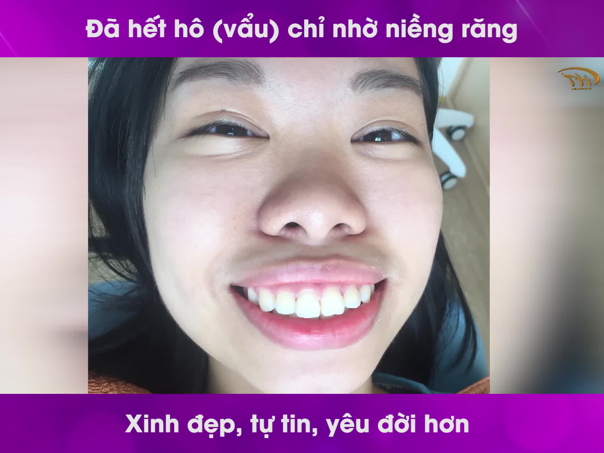 Hô chìa răng đã đành, bạn ấy còn vẩu cả xương hàm nữa thì niềng răng sẽ có kết quả ra sao?
