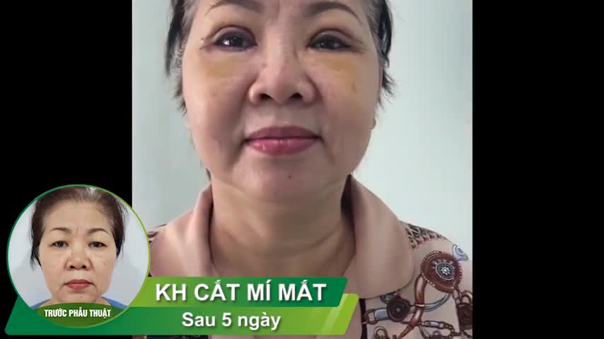 MẮT 1 MÍ, MÍ LÓT, SỤP MÍ làm khuôn mặt trông lờ đờ kéo sắc hơn hẳn.