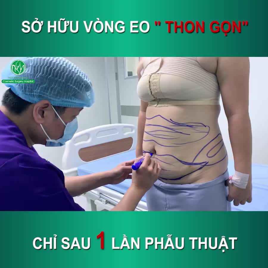 Loại bỏ hoàn toàn lượng mỡ thừa đáng kể chỉ sau 1 lần phẫu thuật