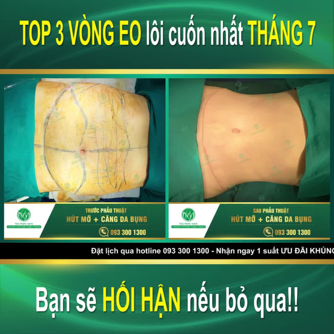 Hút Mỡ + Căng Da Bụng tại Bệnh viện Thẩm mỹ Ngô Mộng Hùng