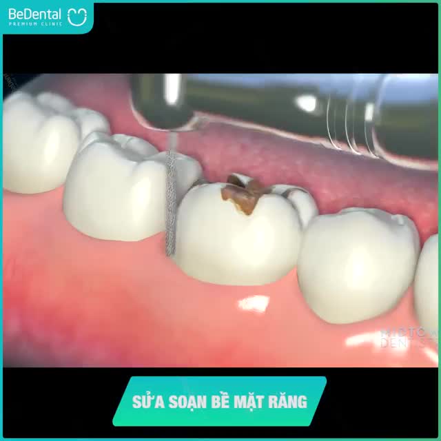 QUY TRÌNH CHẾ TÁC RĂNG SỨ THẨM MỸ CHUẨN QUỐC TẾ TẠI BEDENTAL