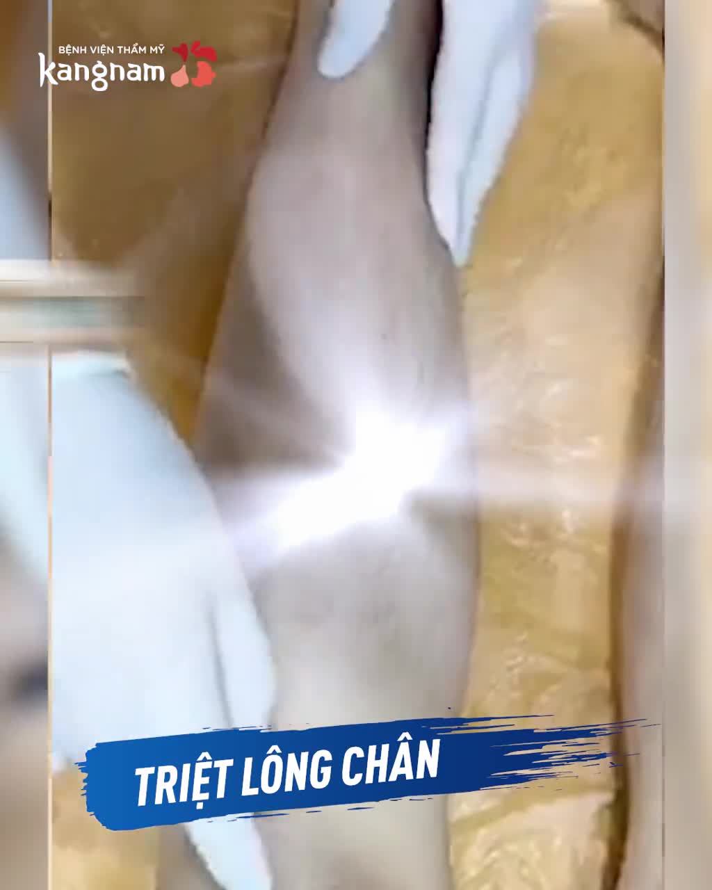 TRIỆT SẠCH LÔNG mọi phân vùng với công nghệ Diode Laser