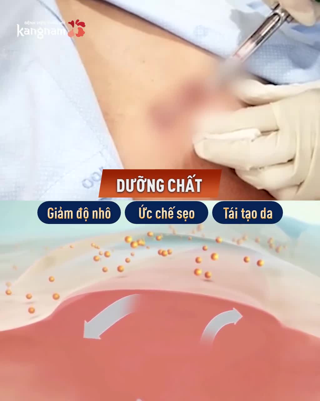 Sẹo lồi ngực - Sẹo bỏng - Sẹo lồi co kéo?