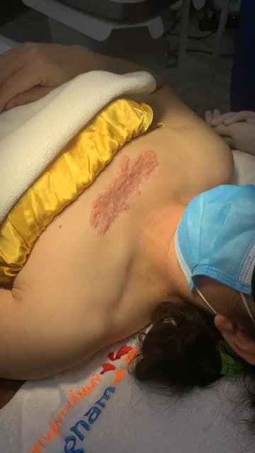 Điều trị sẹo lồi bằng công nghệ chiếu ánh sáng Ella và tiêm thuốc