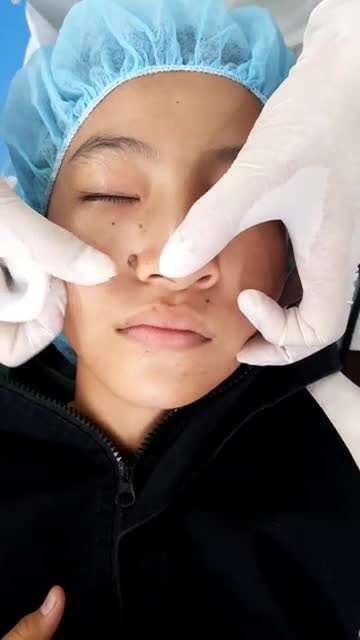 Nốt ruồi to đen trên gương mặt khiến khách hàng tự ti, kém duyên
