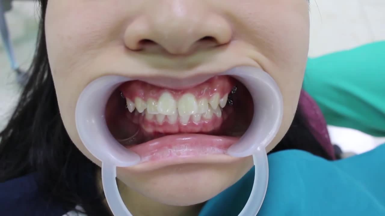 LÀM THẾ NÀO ĐỂ LÀM SẠCH RĂNG KHI ĐEO NIỀNG VỚI BÀN CHẢI KẼ
