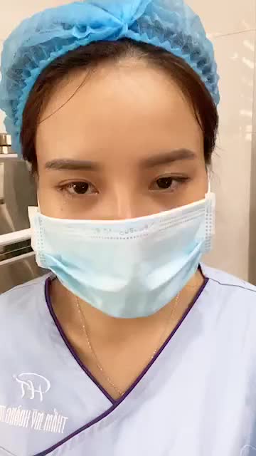 Cải thiện gốc mũi thấp tẹt, đầu mũi tròn hếch, không có chóp mũi cho ca mũi số 92/8 sau nâng mũi Sline.