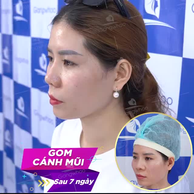 GOM CÁNH MŨI NỘI SOI - KHÔNG ĐỂ LẠI SẸO XẤU