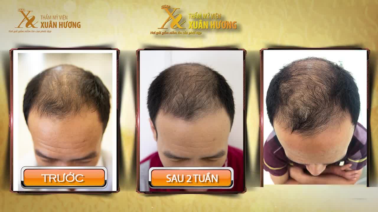 NỖI KHỔ CHỈ ĐÀN ÔNG MỚI HIỂU: TÓC HÓI THƯA, LỘ RÕ "TRÁN BÓNG", MẤT ĐIỂM NGOẠI HÌNH