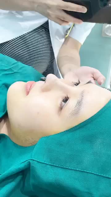 Kết quả thay đổi tuyệt vời cho bạn gái 18 tuổi sau nâng mũi cấu trúc Pureform.