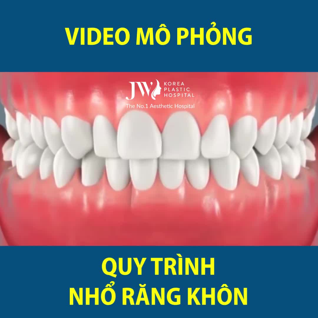 MÔ PHỎNG QUÁ TRÌNH NHỔ RĂNG KHÔN MỌC LỆCH