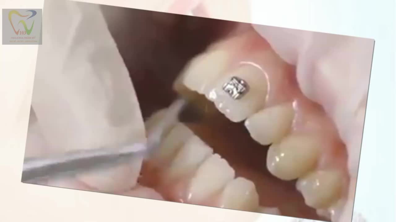 Xem thêm 3 video Niềng Răng của bác sĩ Bs Phạm Sơn