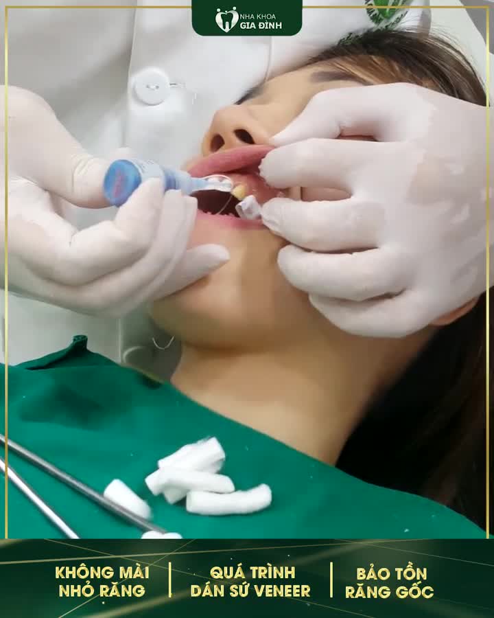 KHẮC PHỤC KHUYẾT ĐIỂM RĂNG Ố VÀNG VỚI DÁN SỨ VENEER KHÔNG MÀI NHỎ