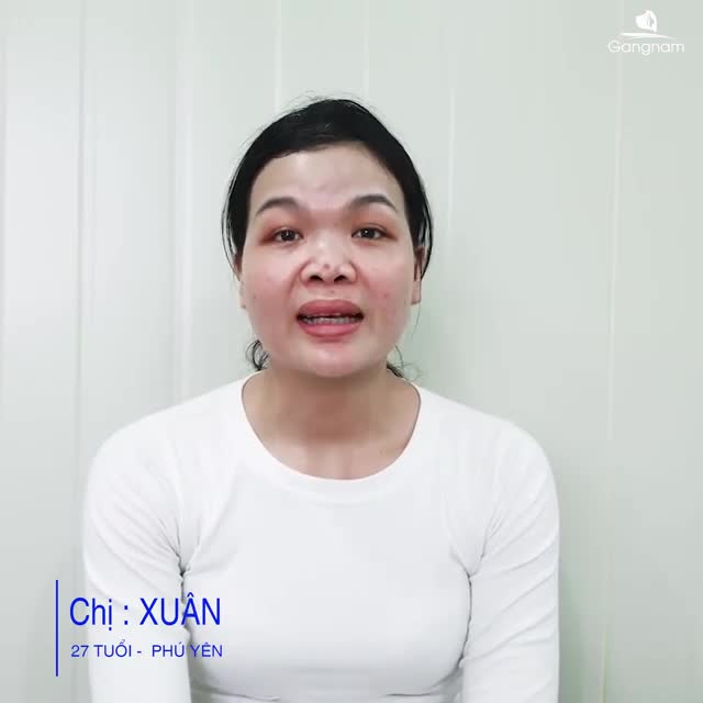 CHIẾC ÁO MỚI CHO MŨI LÕM CỦA CHỊ ĐẾN TỪ DR PARK NHƯ THẾ NÀO?