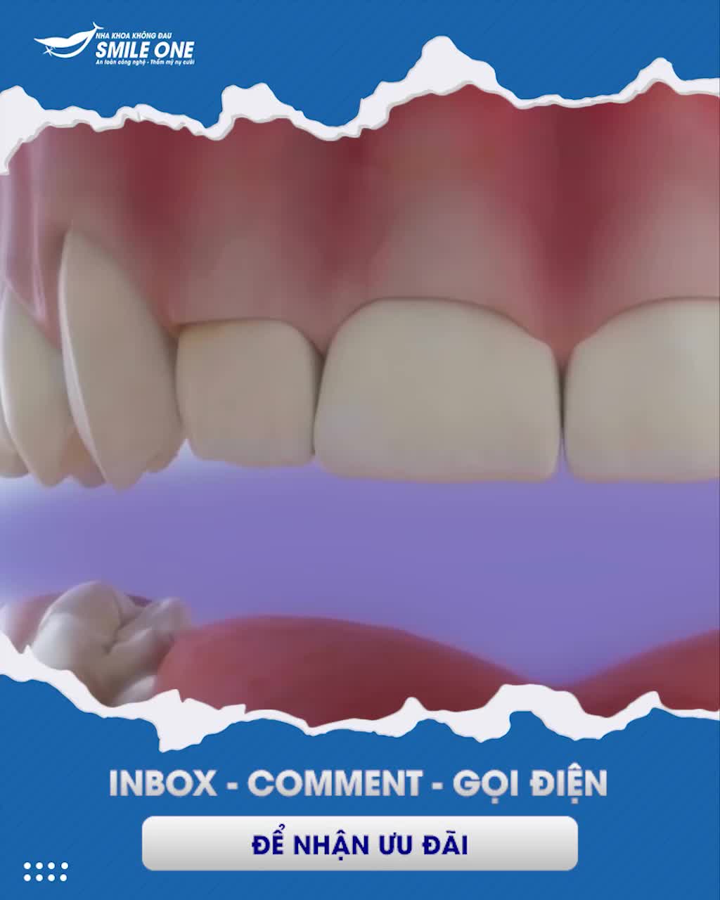 ĐIỀU TRỊ CƯỜI HỞ LỢI TRỌN GÓI CHỈ 3 TRIỆU ĐỒNG